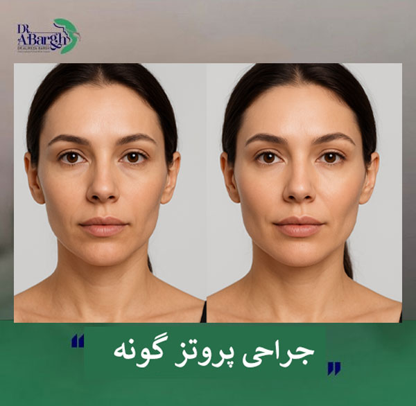 جراحی پروتز گونه