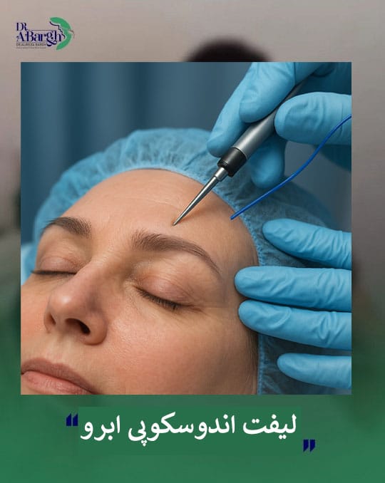 لیفت اندوسکوپی ابرو