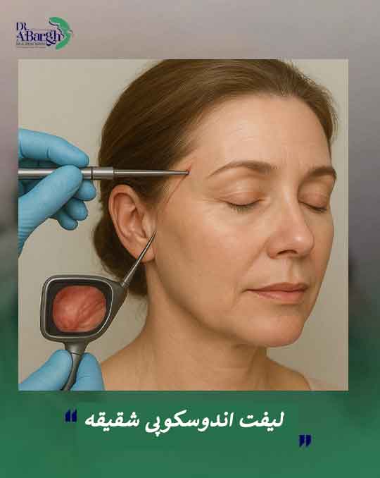 لیفت اندوسکوپی شقیقه