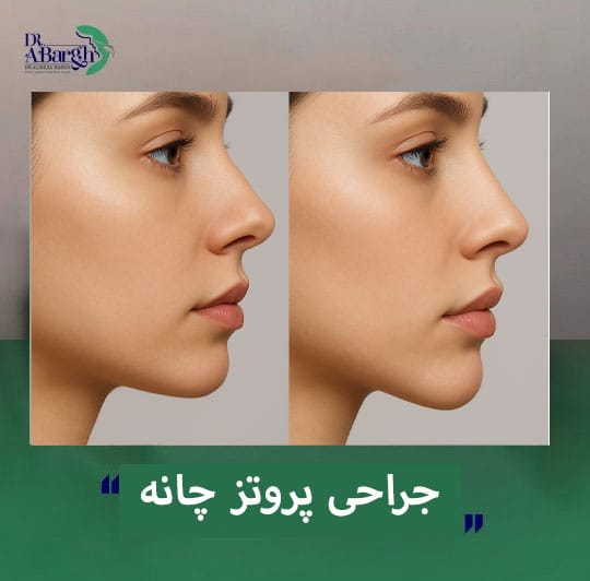 جراحی پروتژ چانه