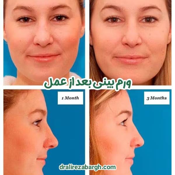 ورم بینی بعد از عمل