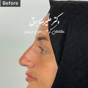 نمونه جراحی بینی